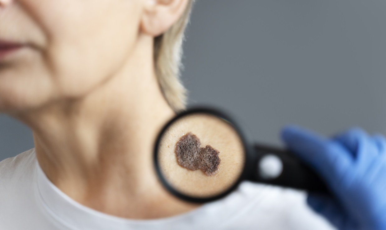 Melanoma, un inquilino no deseado que varía en función de la genética o el género