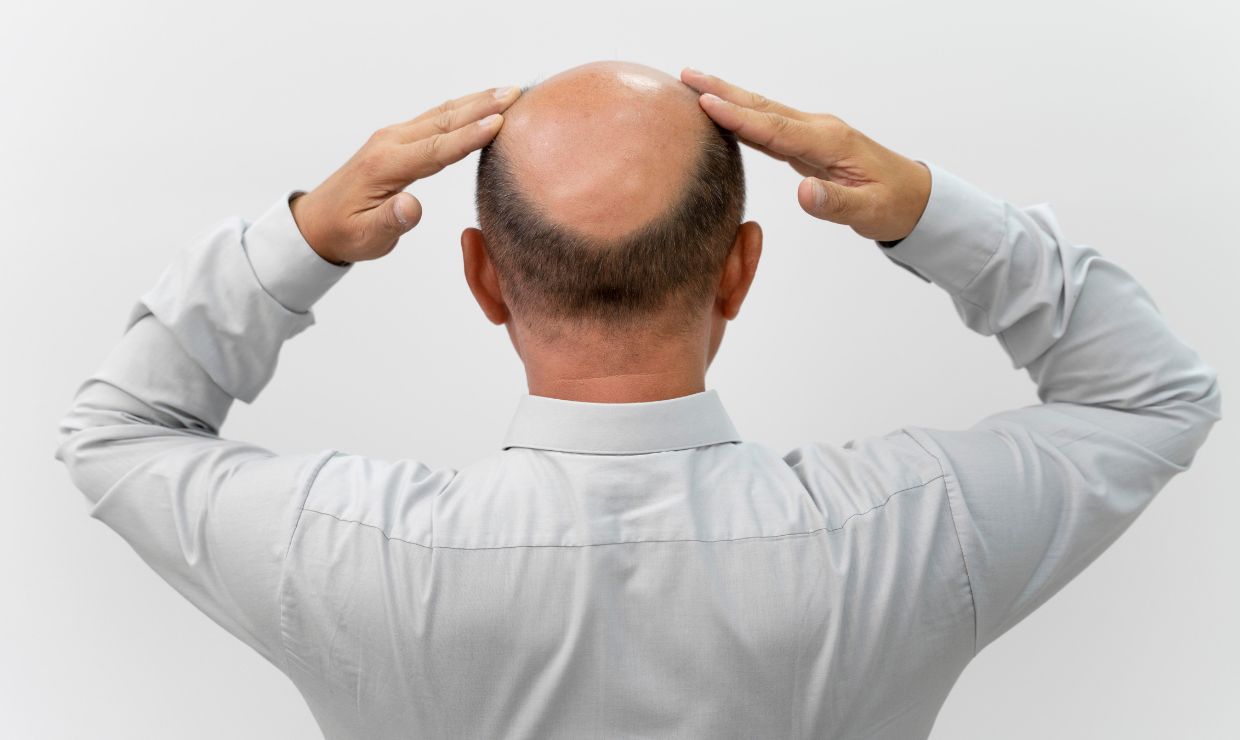 España lidera la prevalencia mundial de alopecia masculina con un 44,5% de afectados