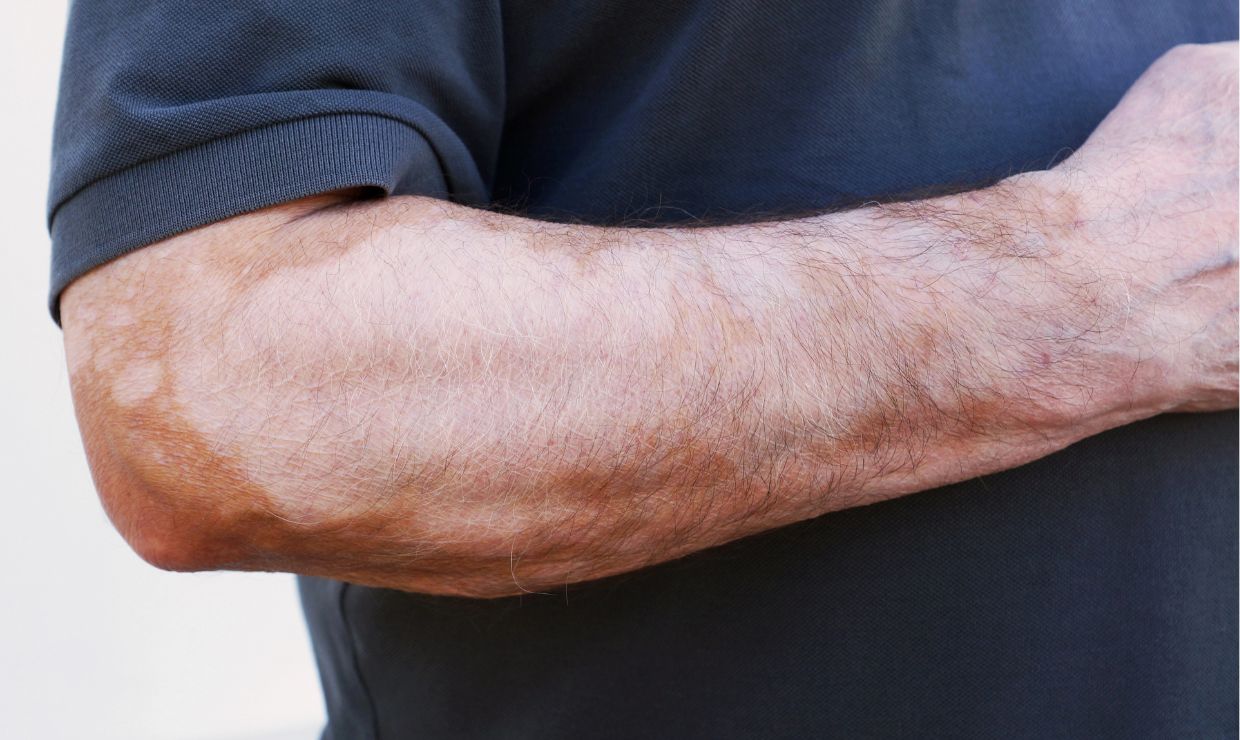 El farmacéutico, aliado esencial frente al vitíligo