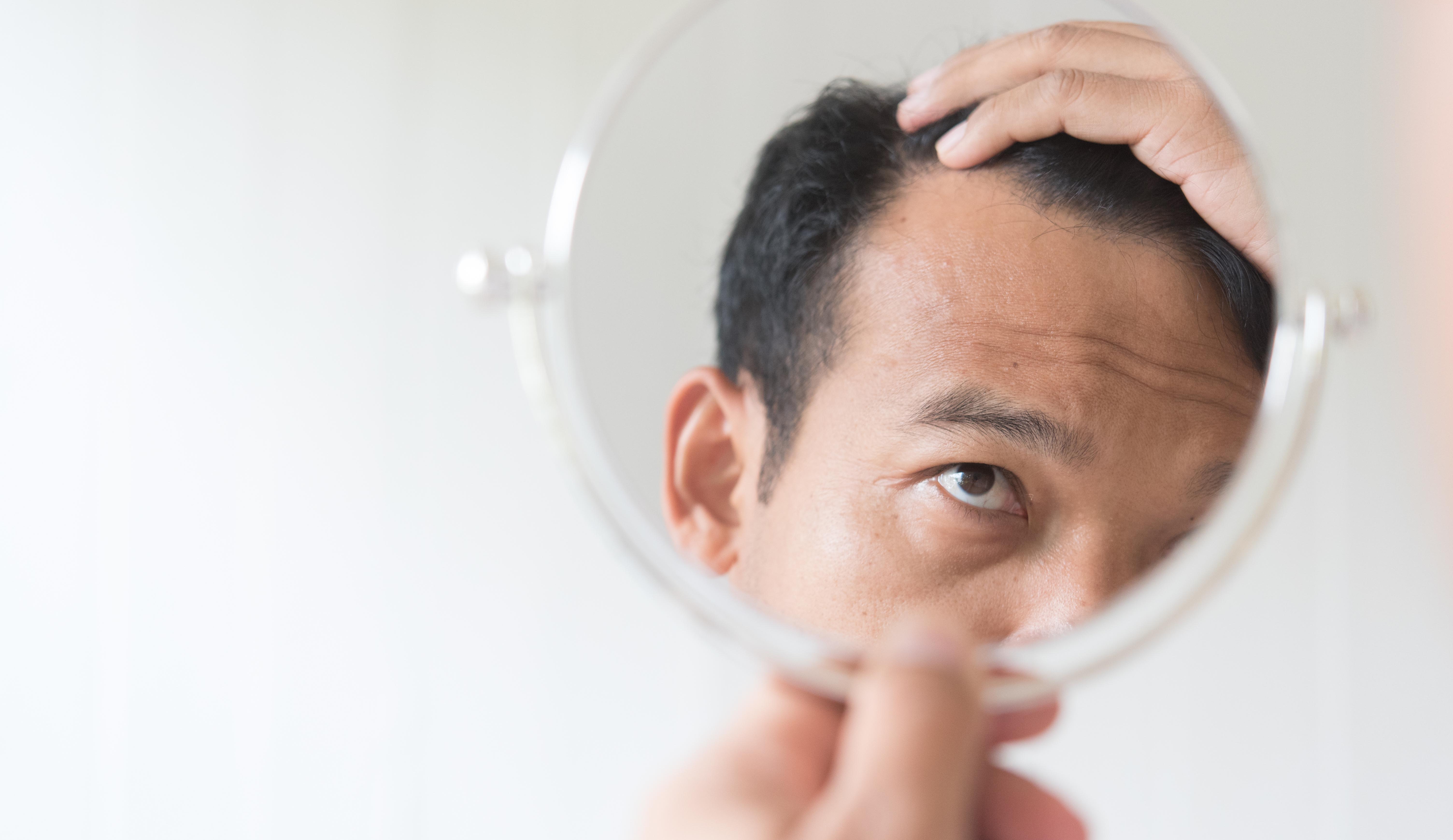 Persona con alopecia areata