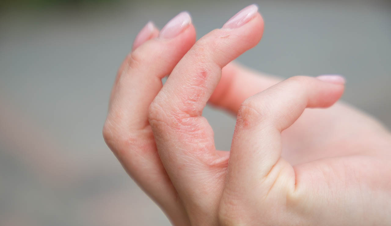 Eccema dishidrótico