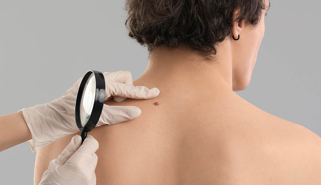 Hombre con lunar en la espalda