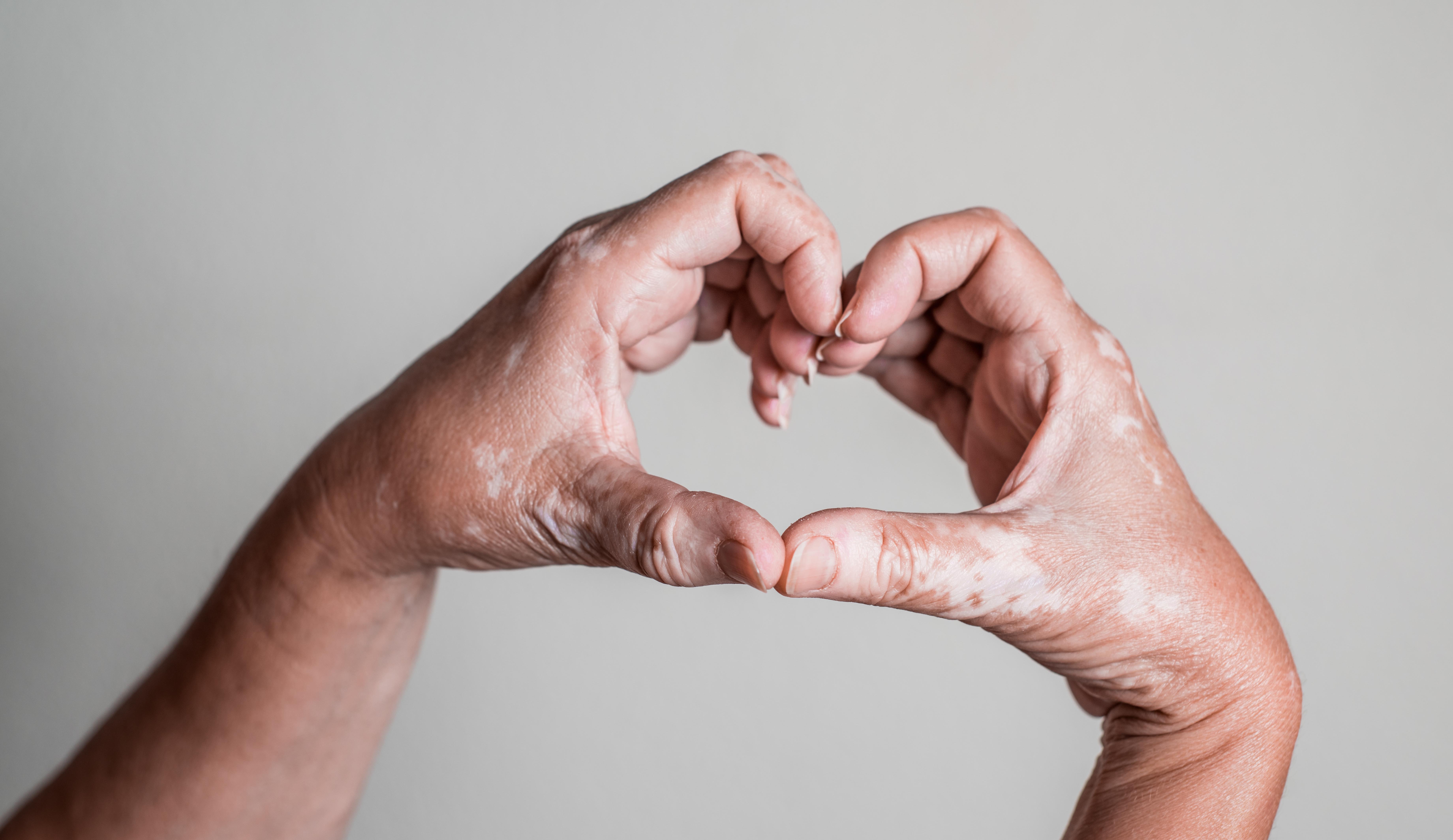 Manos de una persona con vitíligo