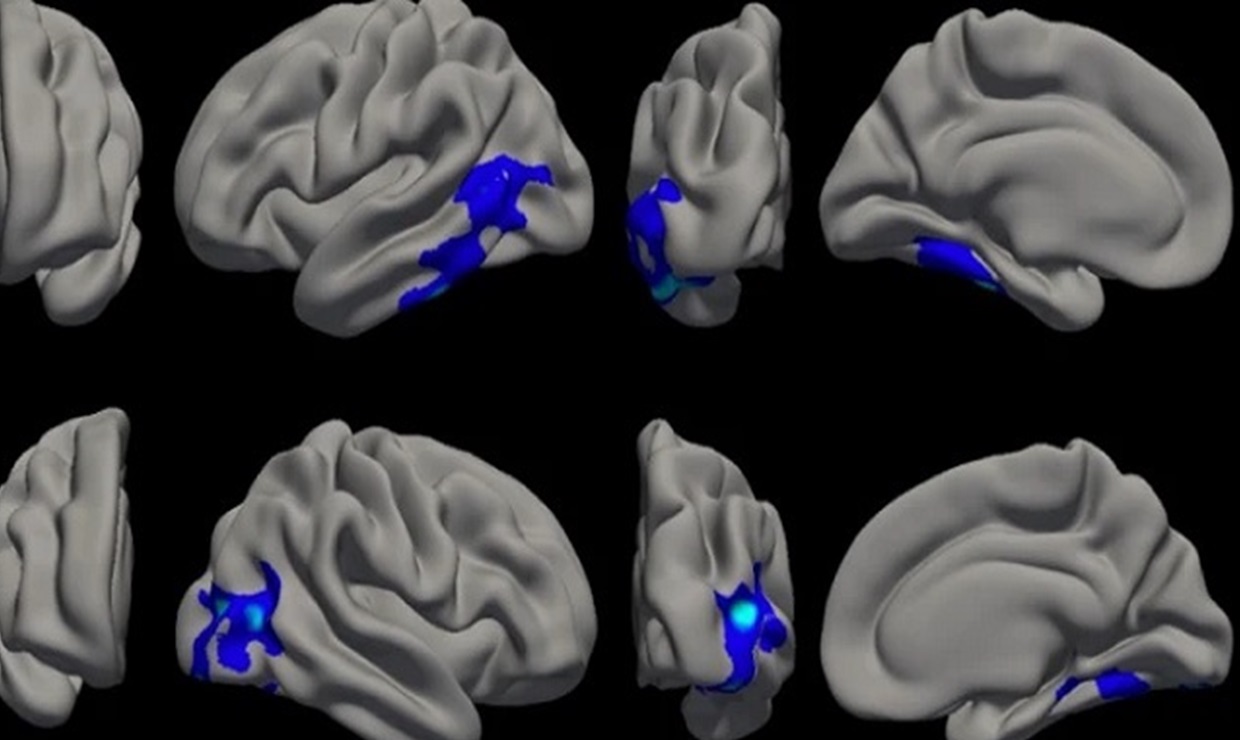 Identifican perfiles psicológicos que pueden influir en la evolución de la salud mental durante el envejecimiento