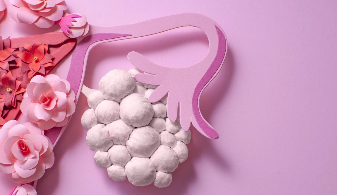 Ovario poliquístico y SOP: diferencias que todo farmacéutico debe conocer