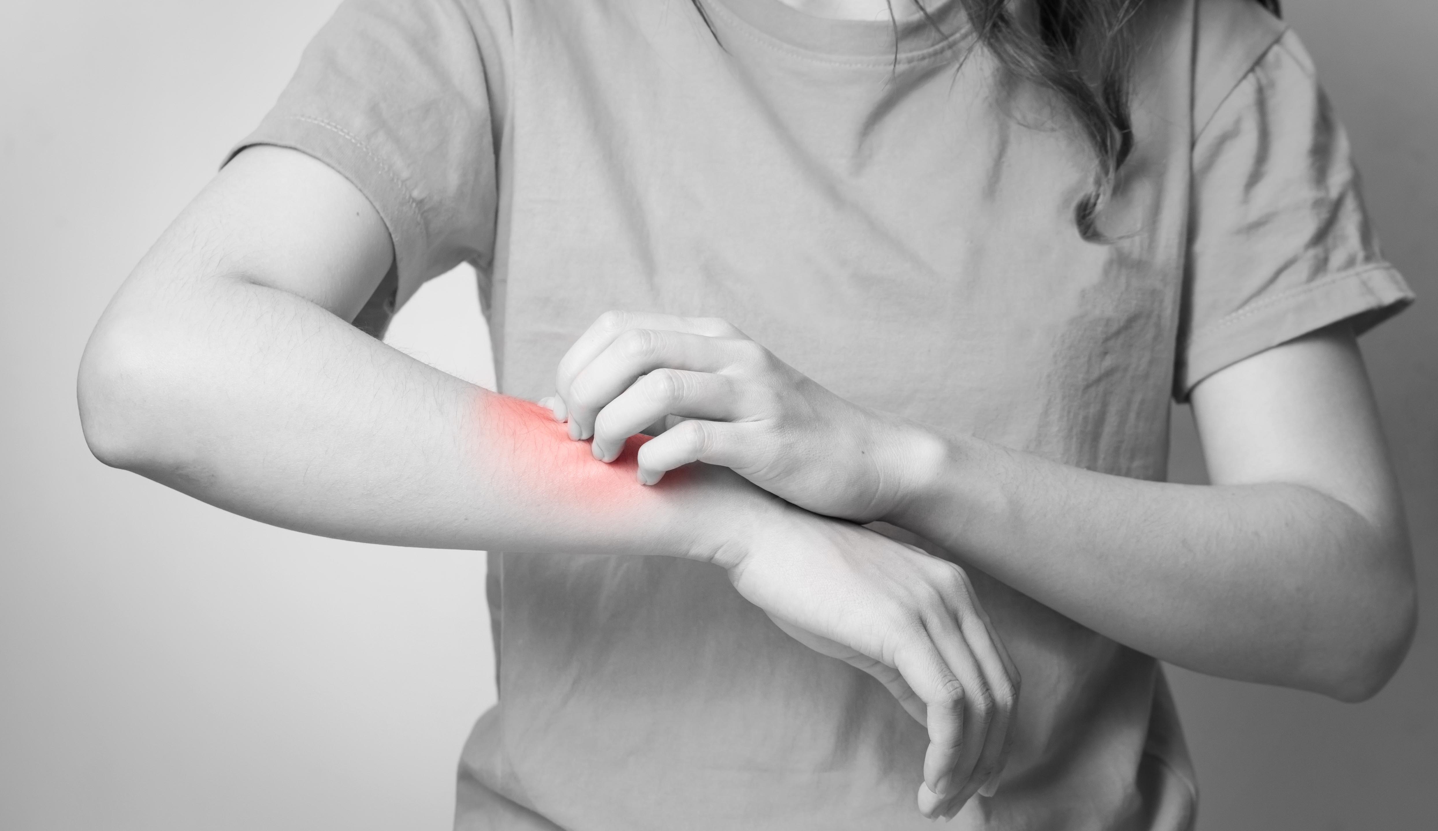 Persona con hidradenitis supurativa