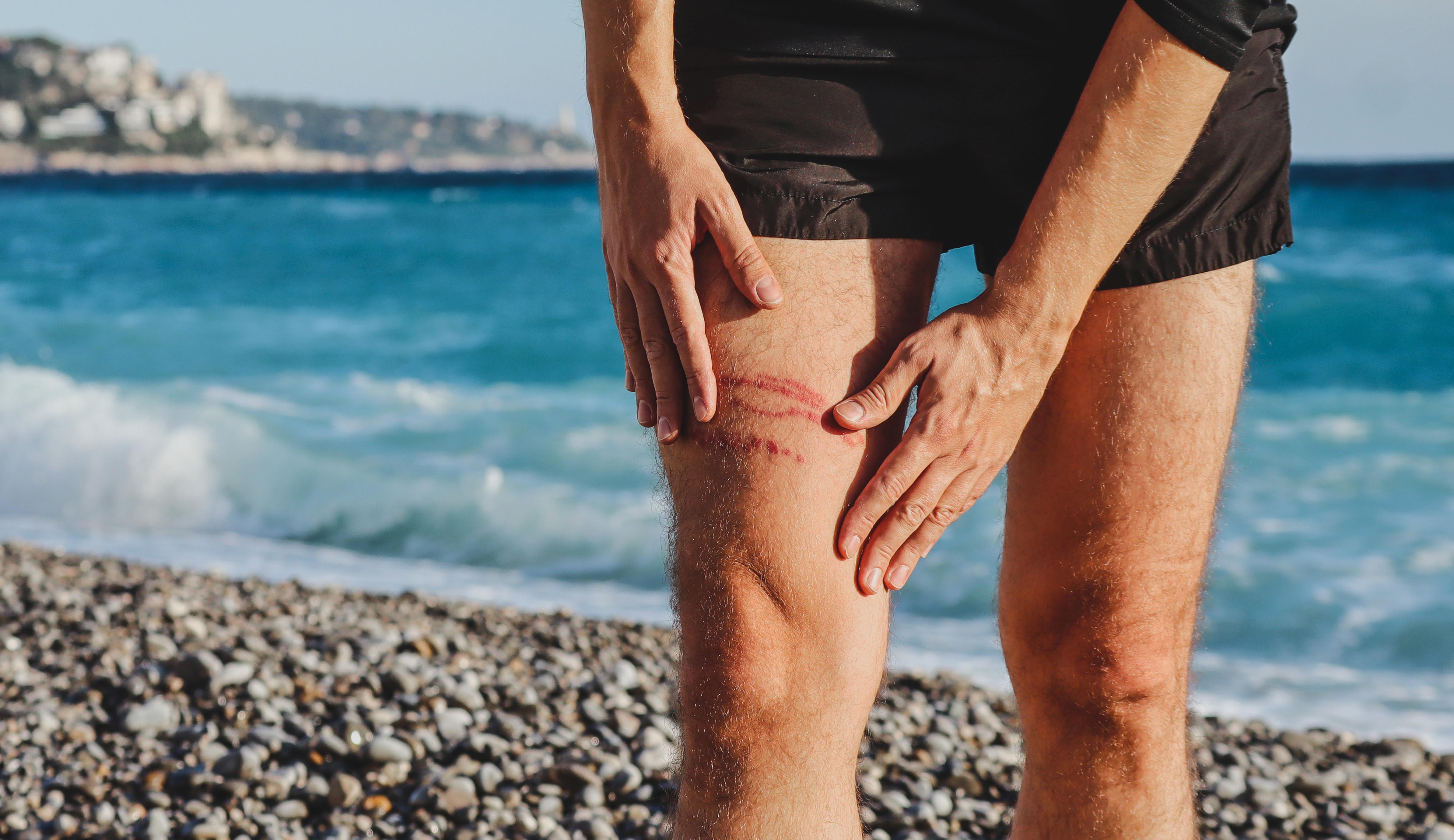 Persona con picadura de medusa
