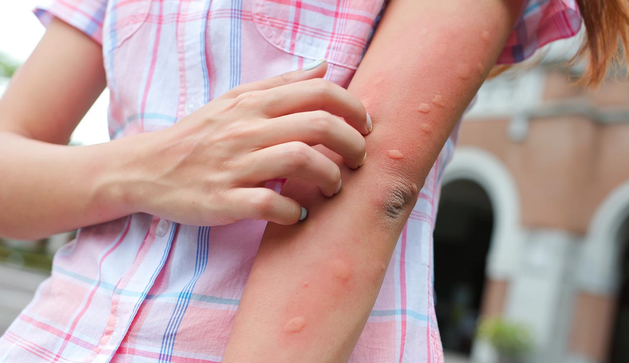 Picaduras de mosquitos en un brazo