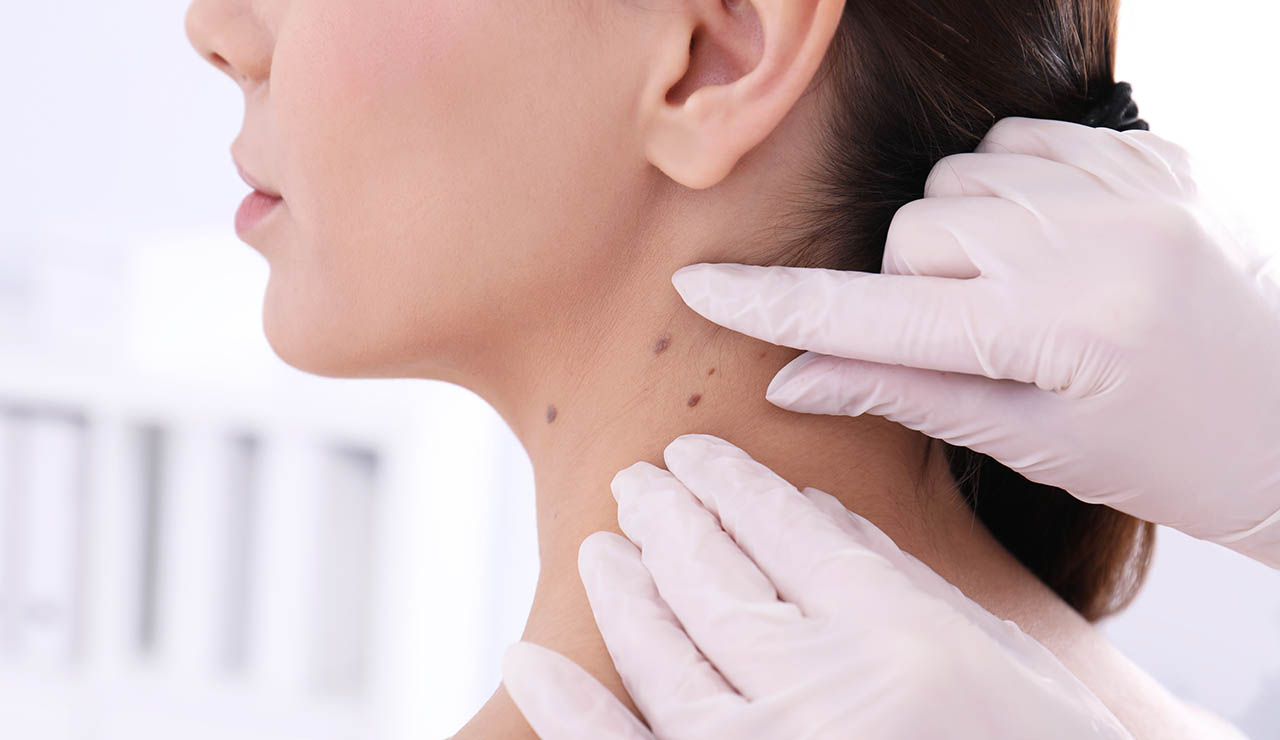 Inspección de lunares