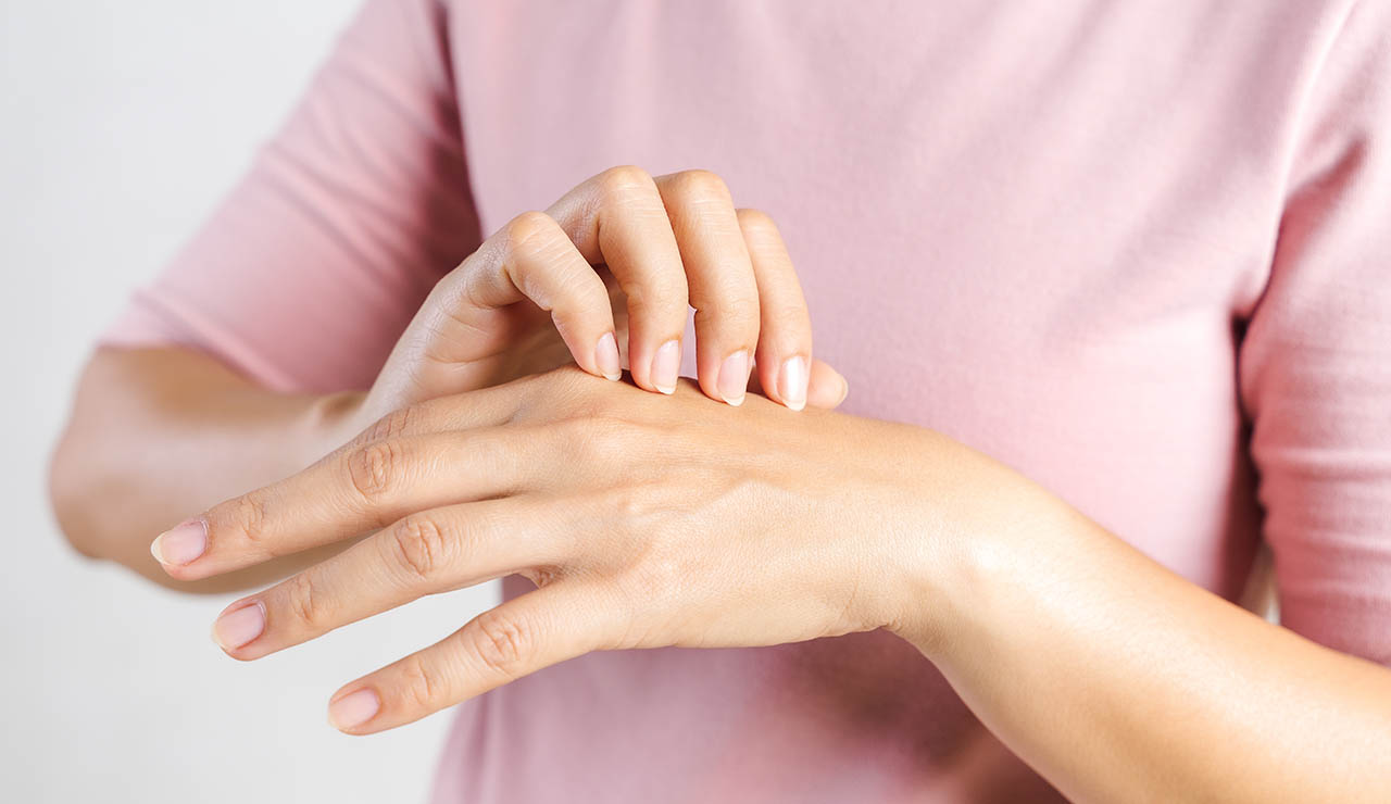 Mujer con psoriasis en la mano