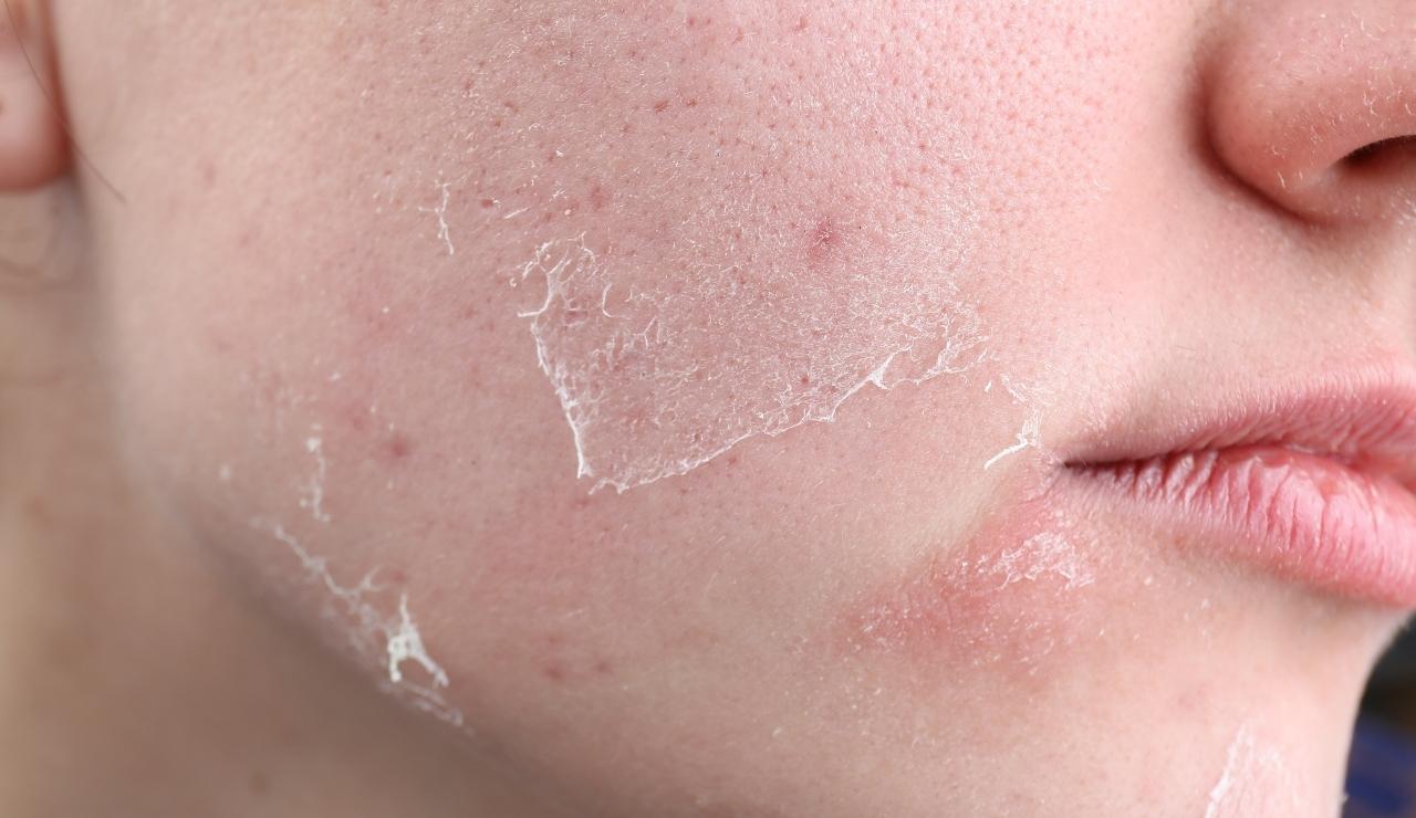 Piel alípica: qué es y recomendaciones para un cuidado adecuado