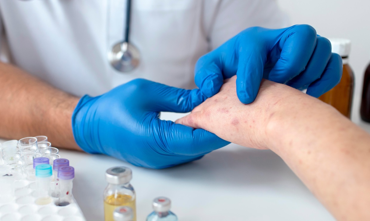 La OMS declara la emergencia internacional por mpox: la nueva variante, un desafío global
