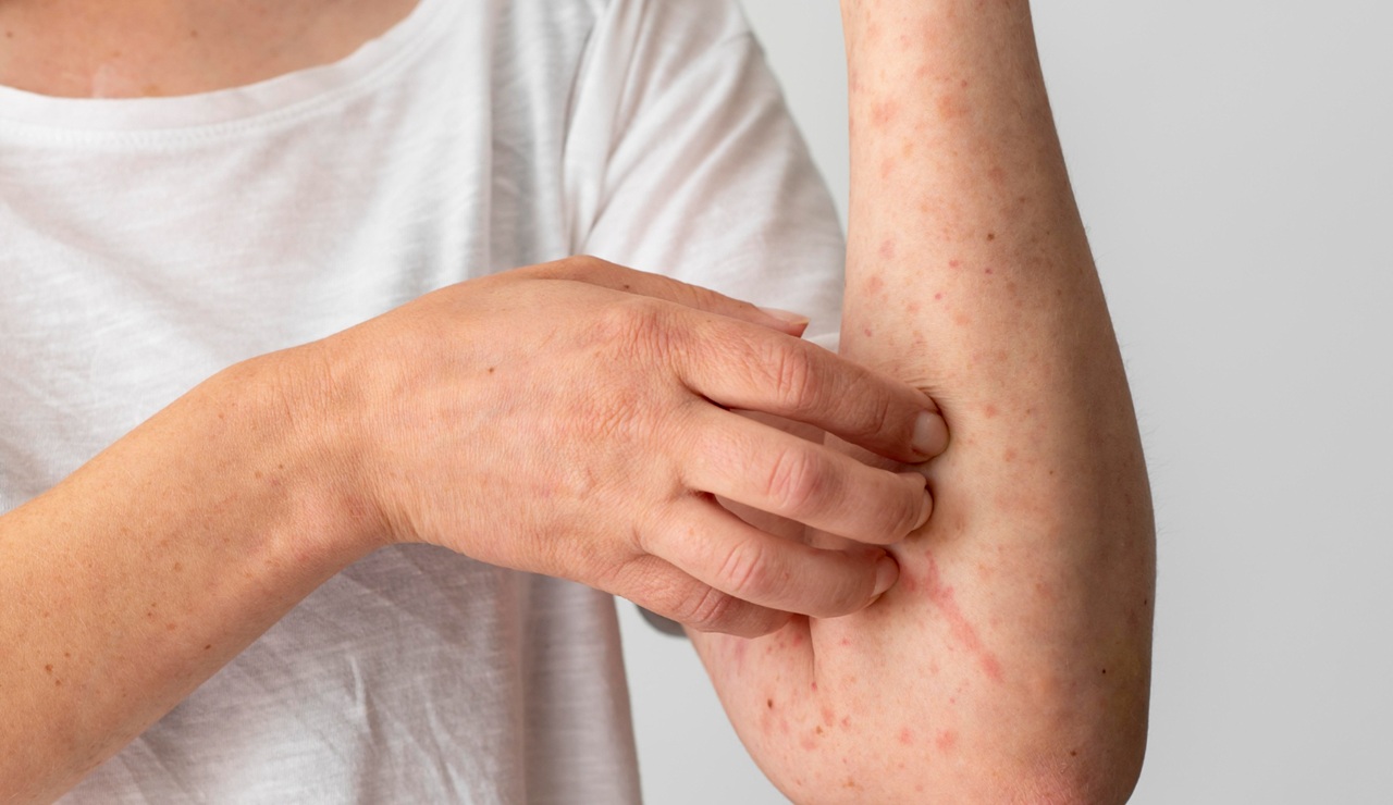 Del tratamiento sintomático a la intervención sobre la inflamación sistémica: así ha evolucionado el abordaje de la dermatitis atópica