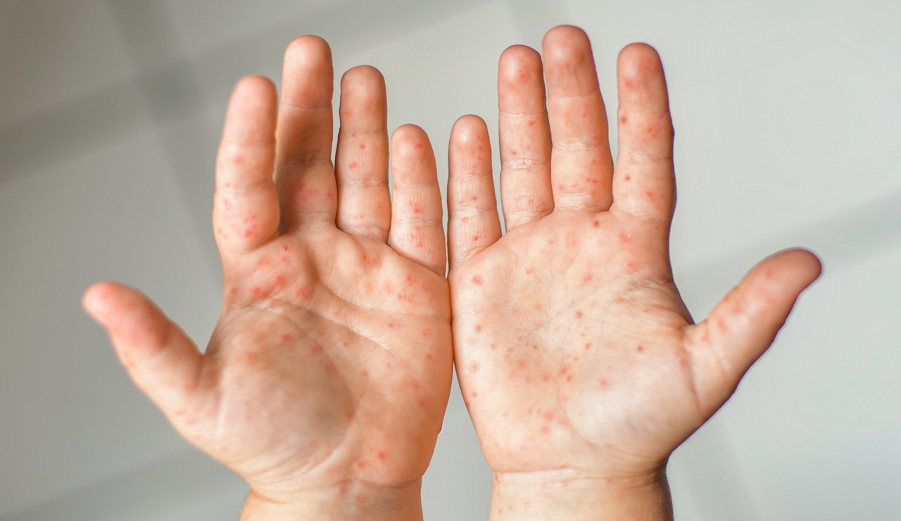 Enfermedad de manos, pies y boca, el virus que afecta a niños y adultos: ¿cómo aliviar los síntomas?