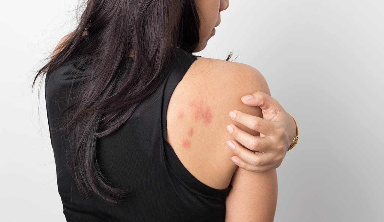 Mujer con ronchas de urticaria