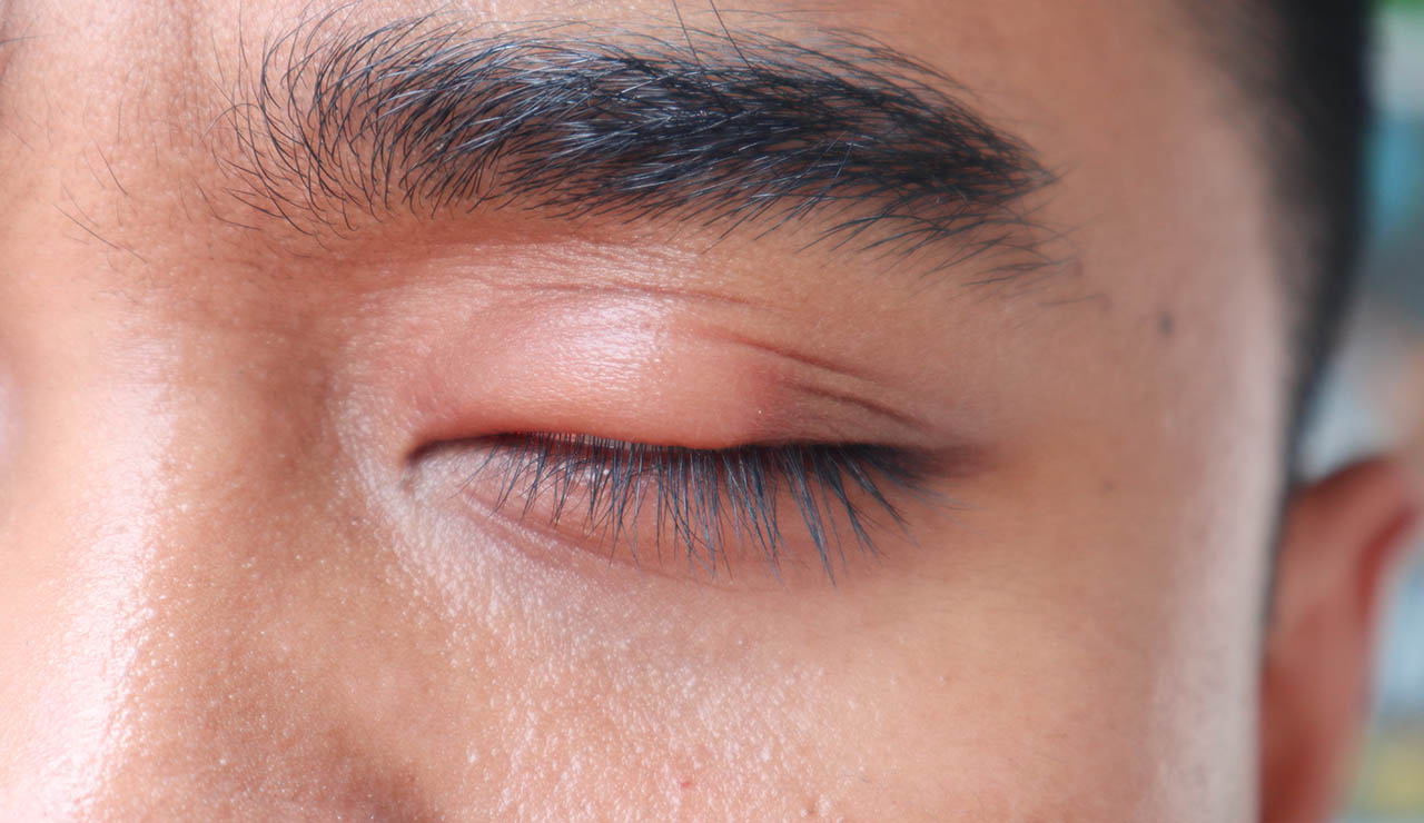 Ojo con el párpado hinchado