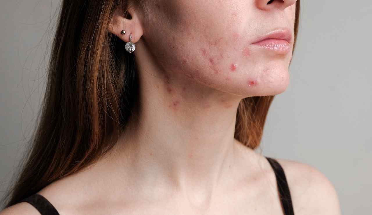 Tres activos para controlar los brotes de acné