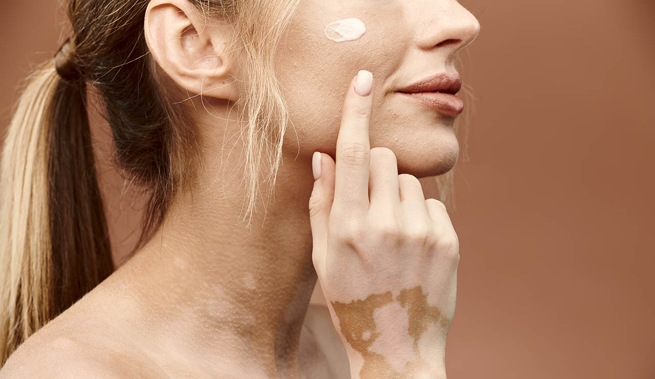 Mujer con vitíligo aplicando crema sobre su rostro