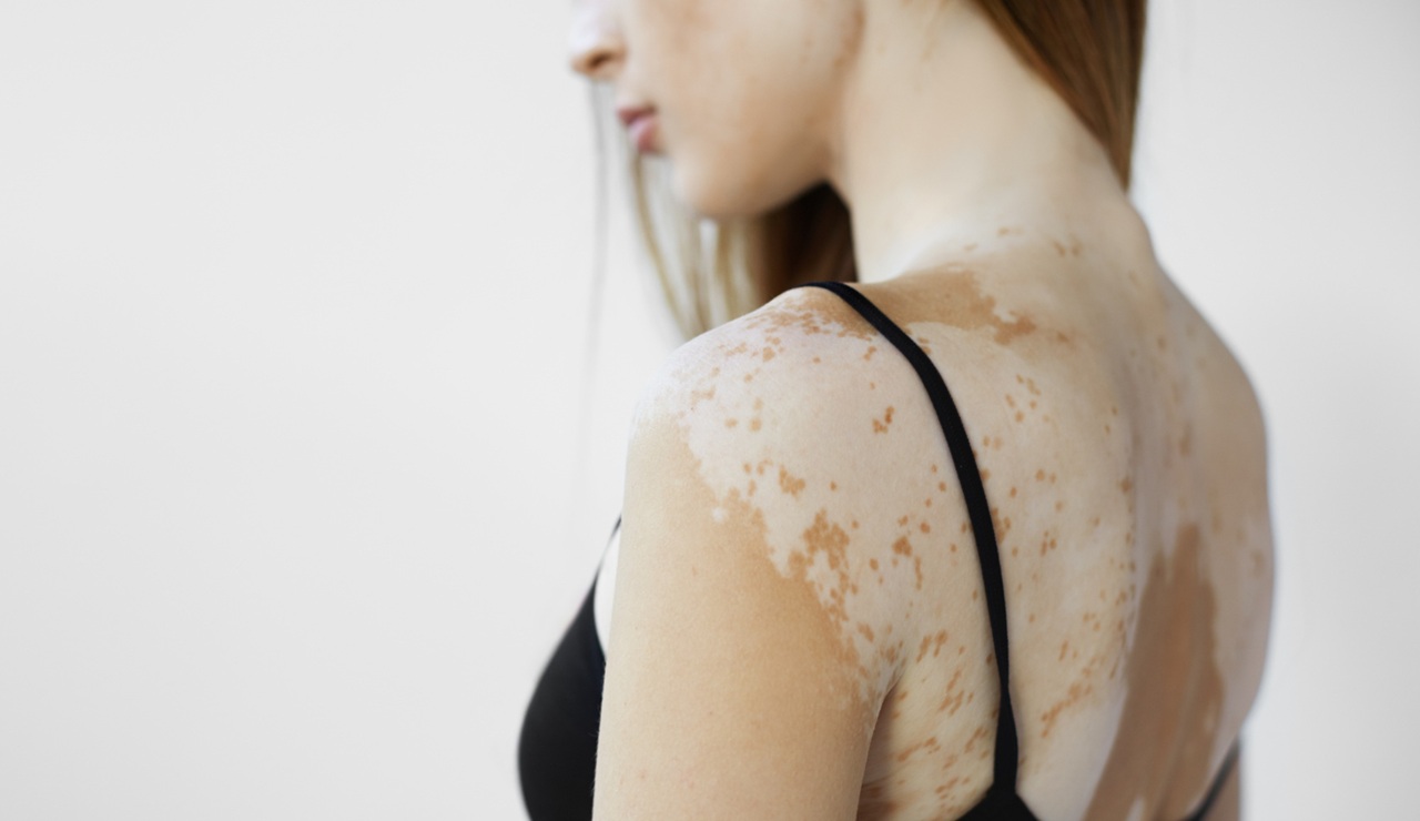 Manchas blancas en la piel: por qué aparecen y qué cuidados ayudan a prevenirlas