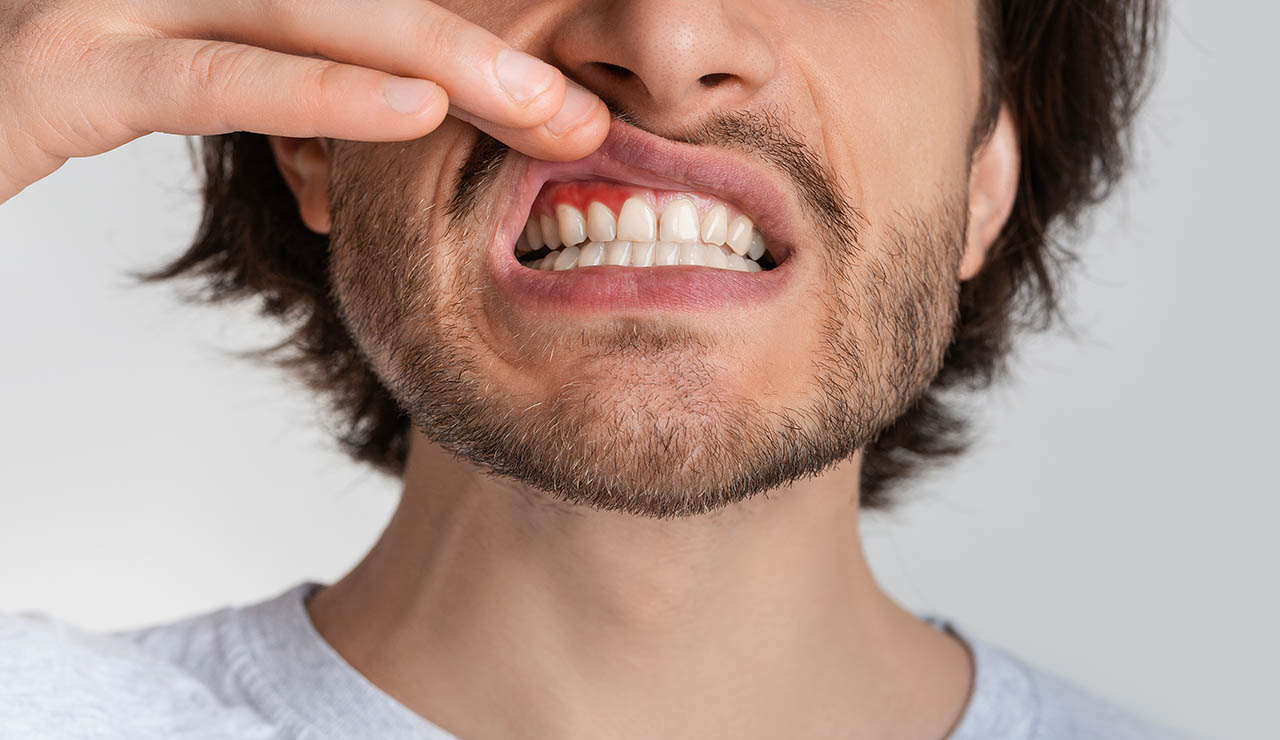 Hombre con encías rojas e inflamadas