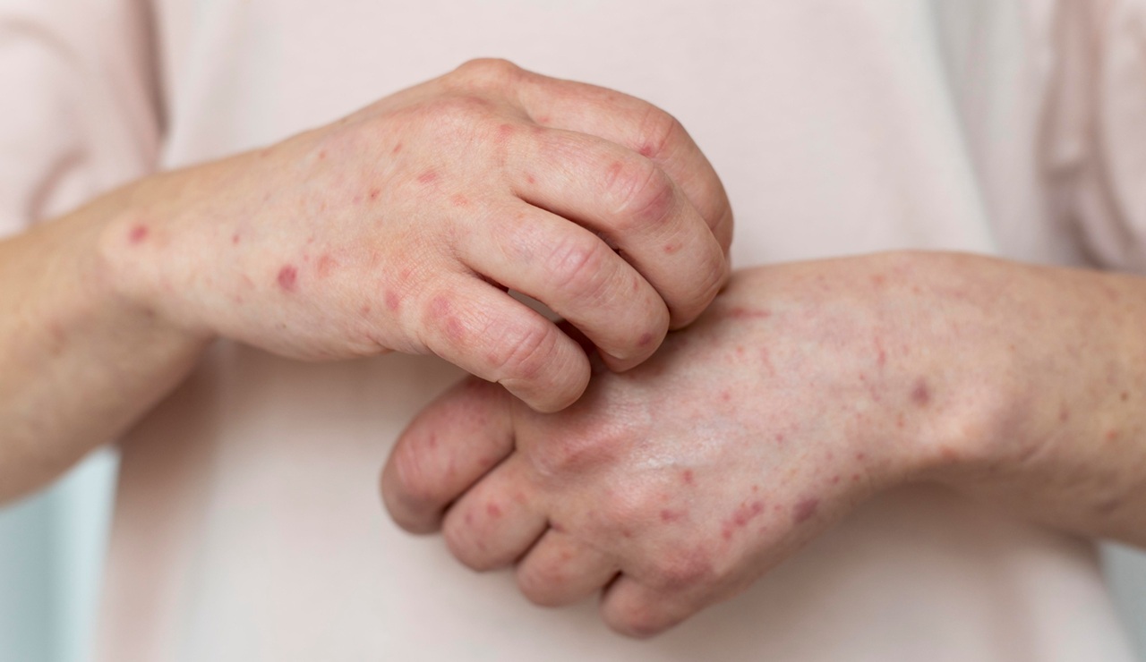Cómo tratar la sarna y prevenir la propagación de esta contagiosa enfermedad de la piel
